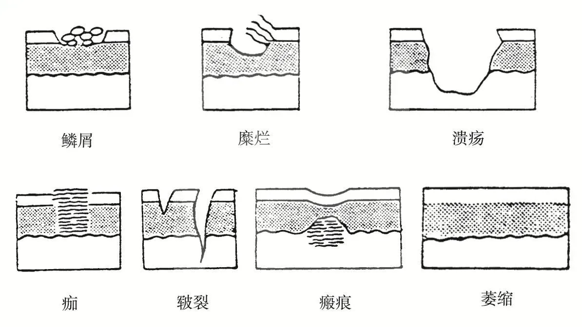 继发性皮损