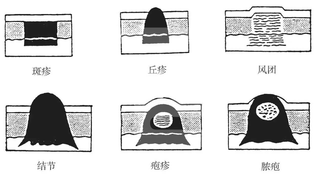 原发性皮损